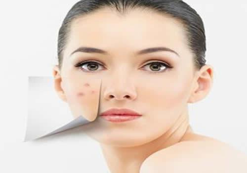 痤疮长什么样 痤疮怎么解决